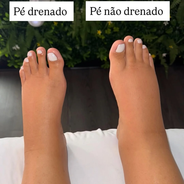 Antes e depois da drenagem linfática, pé drenado e não drenado