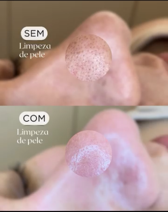 Comparação de pele sem e com limpeza de pele