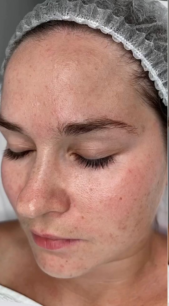 Pele antes do rejuvenescimento facial