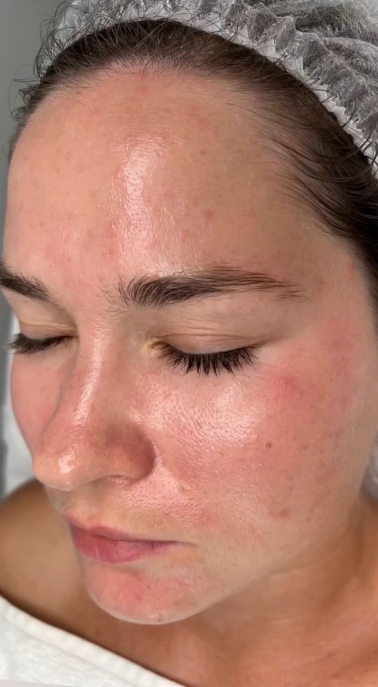 Pele depois do rejuvenescimento facial