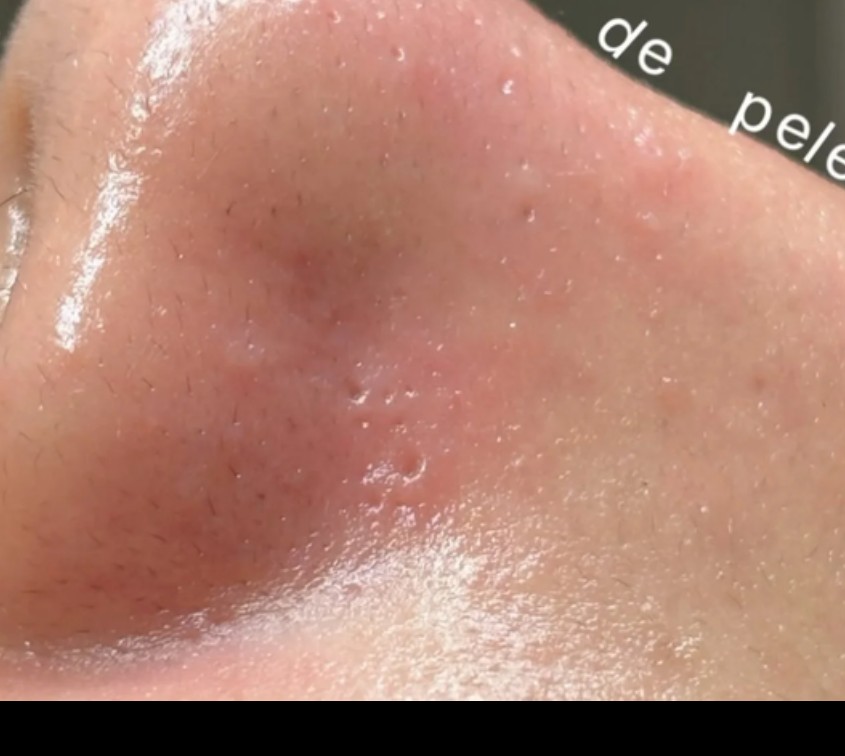 Pele depois da limpeza de pele profunda